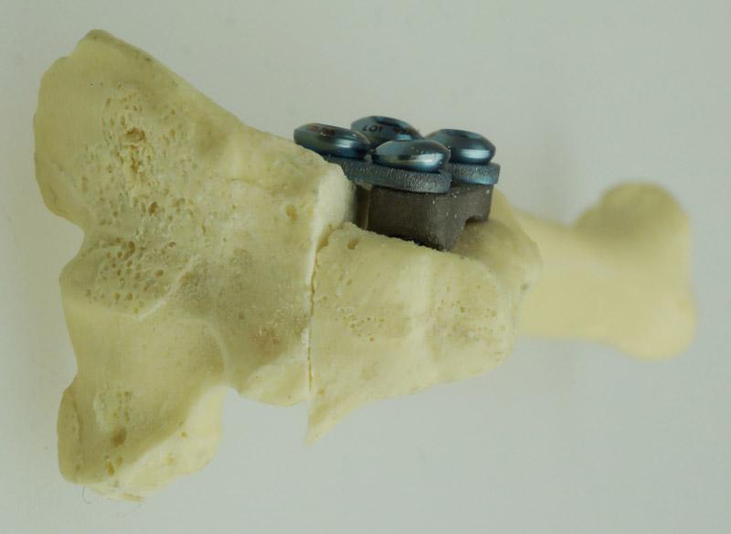 2.0mm "Petite" Patella Spacers