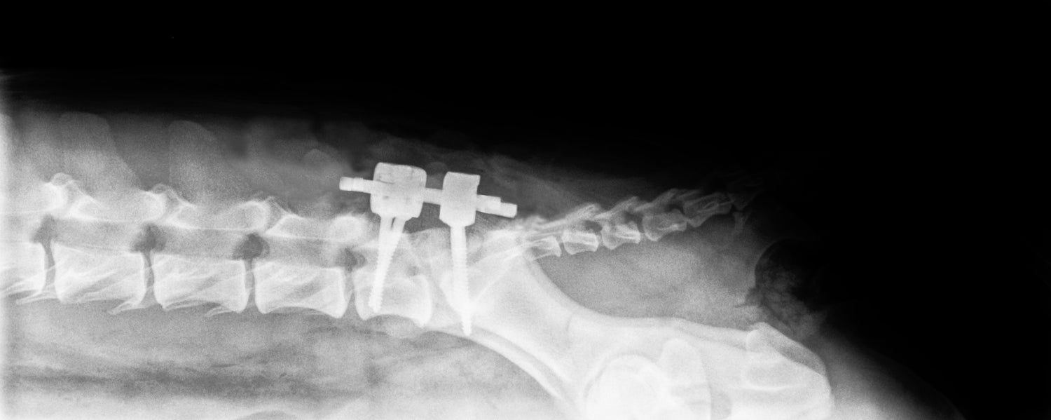 Spinal Course: Pedicle Screw and Intervertebral Cage Systems