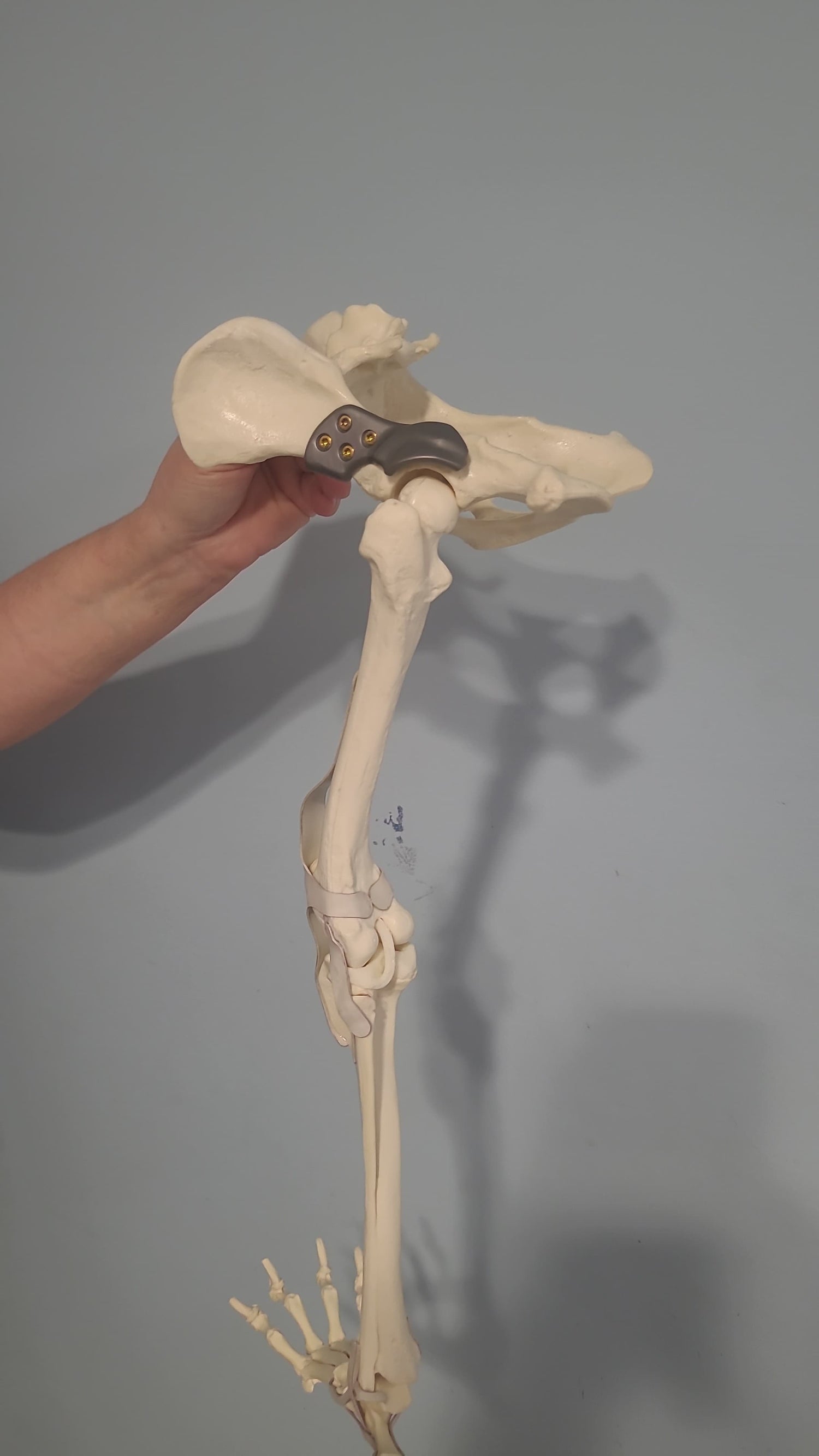 3D HIP Course: Shelf Arthroplasty of Dorsal Acetabular Rim