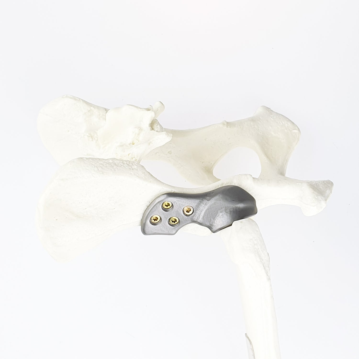 3D Hip Course: Shelf Arthroplasty of Dorsal Acetabular Rim