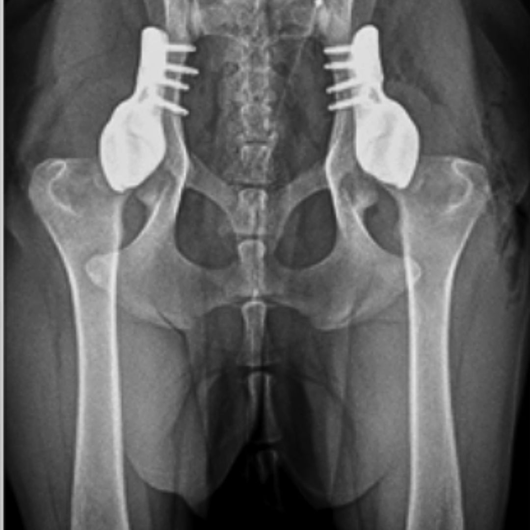 3D Hip Course: Shelf Arthroplasty of Dorsal Acetabular Rim