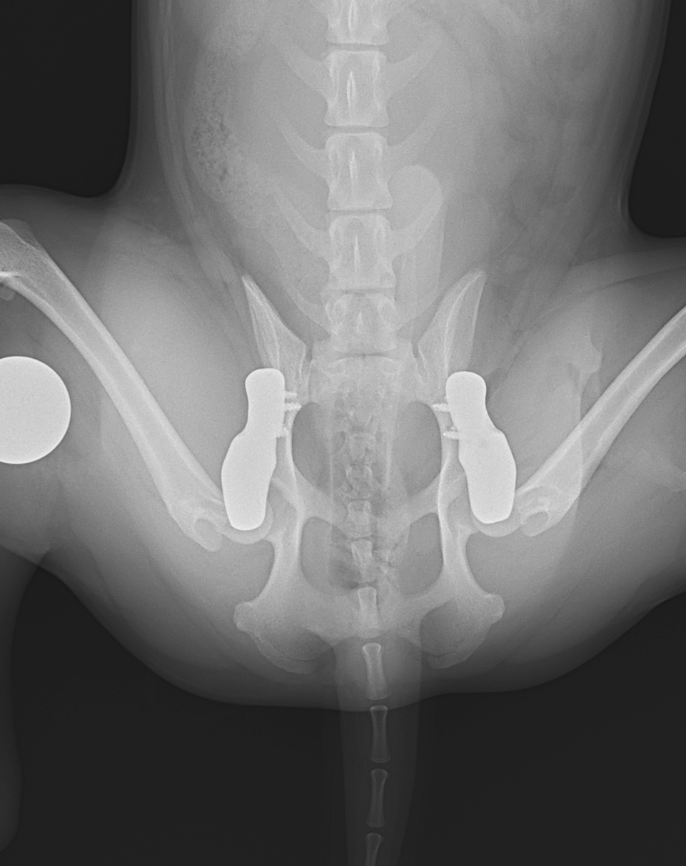 3D HIP Course: Shelf Arthroplasty of Dorsal Acetabular Rim