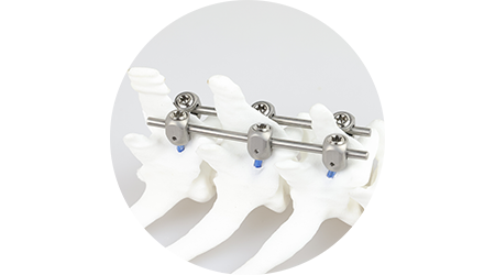 Spinal Course: Pedicle Screw and Intervertebral Cage Systems