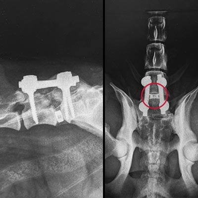 Spinal Course: Pedicle Screw and Intervertebral Cage Systems