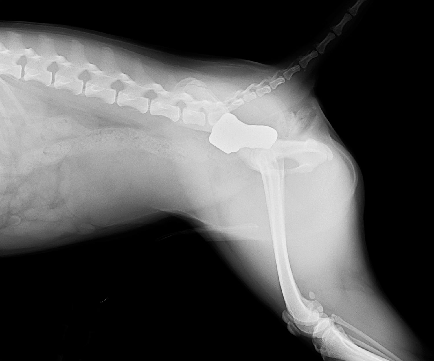 3D Hip Course: Shelf Arthroplasty of Dorsal Acetabular Rim