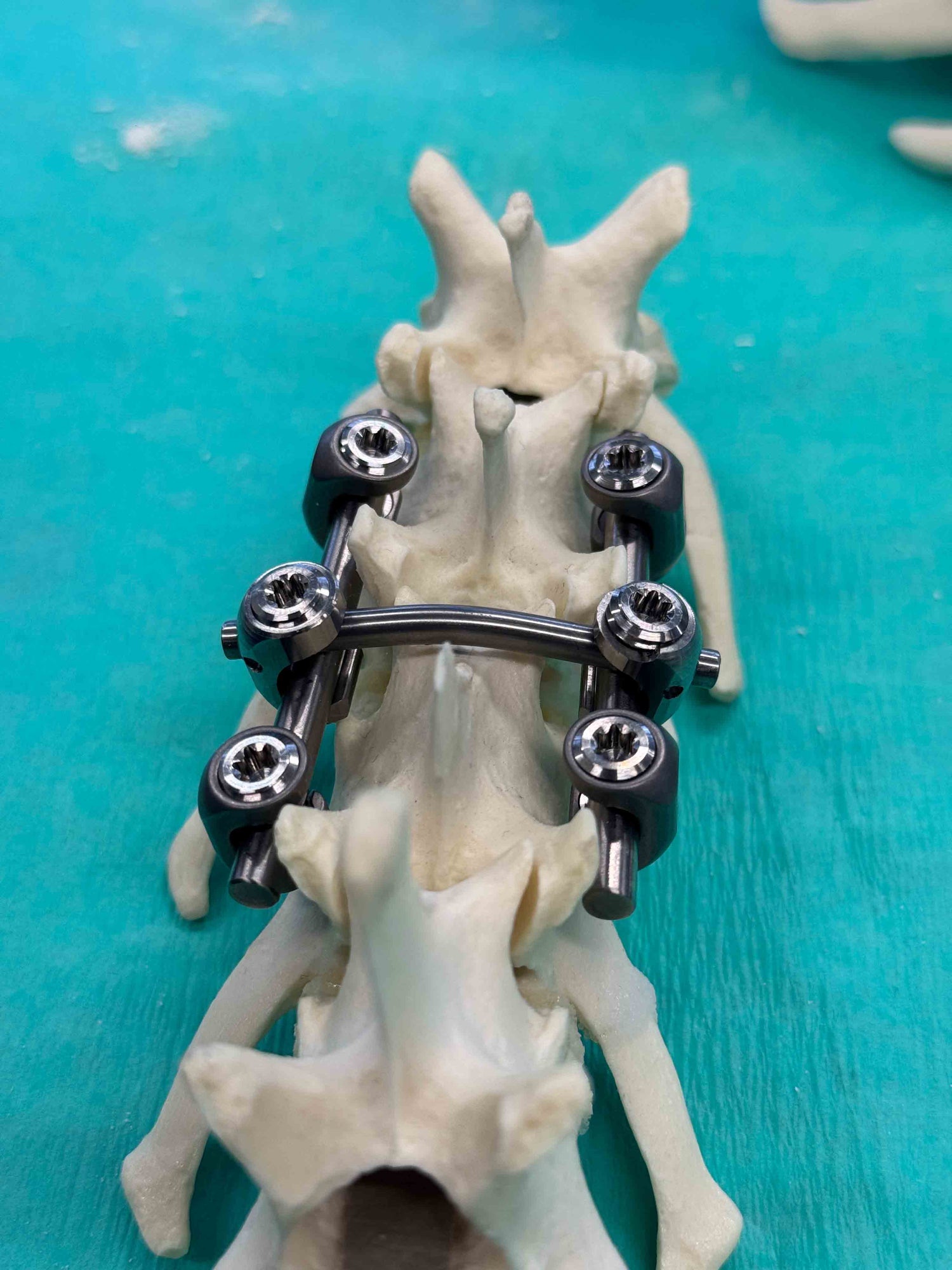 Spinal Course: Pedicle Screw and Intervertebral Cage Systems