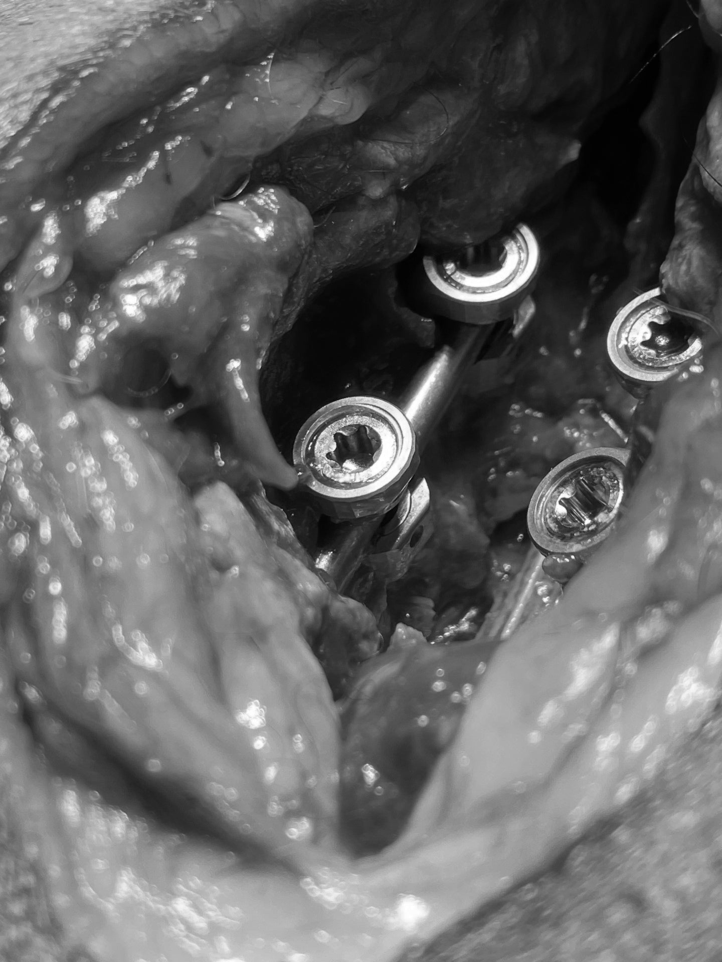 Spinal Course: Pedicle Screw and Intervertebral Cage Systems