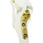 TPLO Swing.png__PID:063b17ea-1924-480e-afdd-77928bac47c8