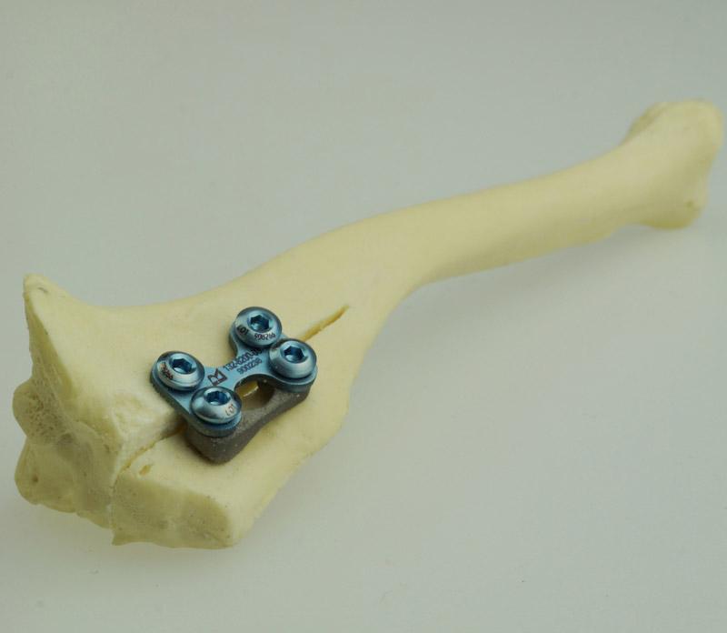 2.0mm "Petite" Patella Spacers